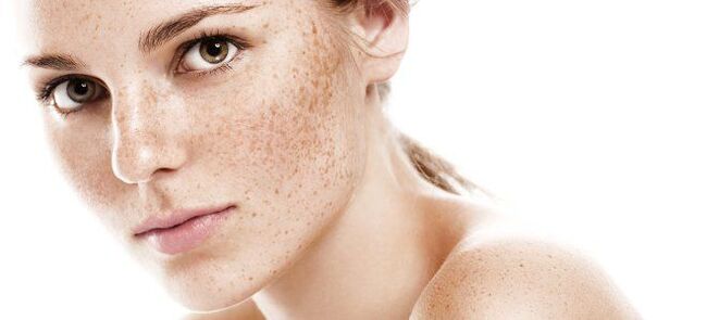 freckles as an indication for split rejuvenation