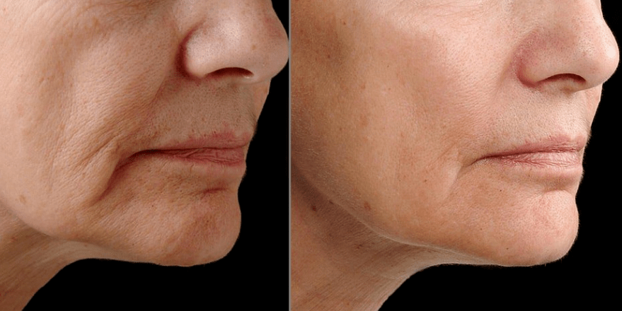 Fractionary Laser rejuvenation - Effect