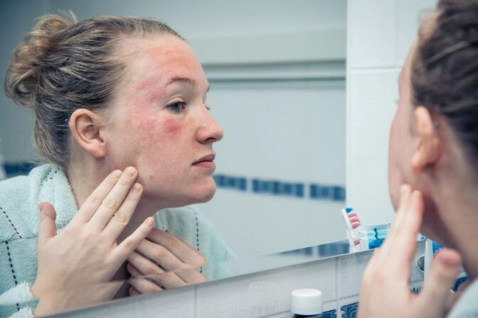 Chronic skin diseases at the aggravation stage