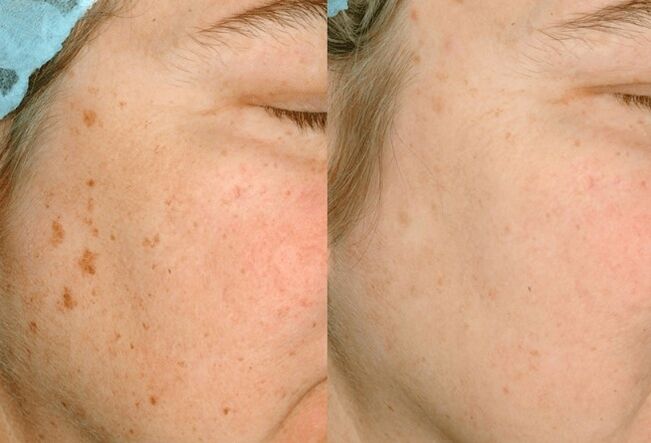 Elimination of pigmentation on the skin