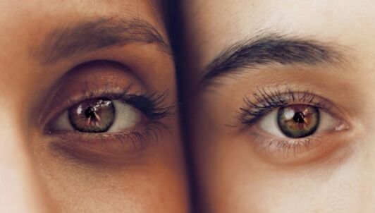Dark circles under the eyes
